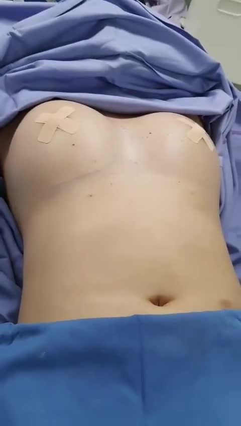 CASE NÂNG NGỰC NỘI SOI TẠI BỆNH VIỆN QUỐC TẾ Share nhận thêm ưu đãi 5%