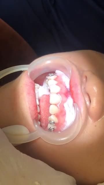 GẮN MẮC CÀI điều trị răng HÔ + XÔ RĂNG tại Nha Khoa Vân Anh !!!