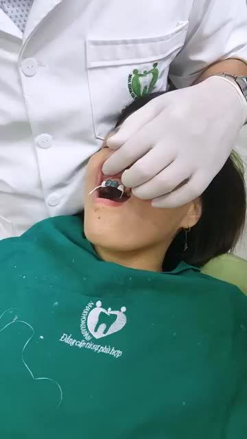 Quá trình dán sứ 16 Veneer của KH Nguyễn Lượng