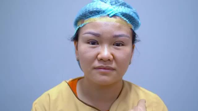Biến hóa mắt 1 Mí thành 2 MÍ xinh lung linh tại Dr.Hải Lê