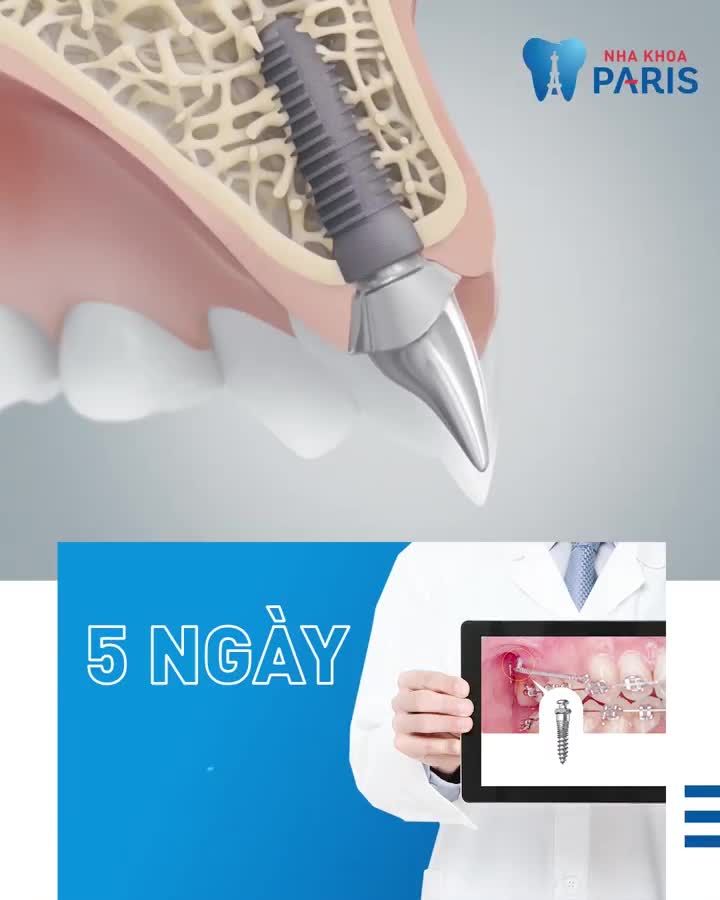 Mất răng vị trí nào - Trồng lại vị trí đó