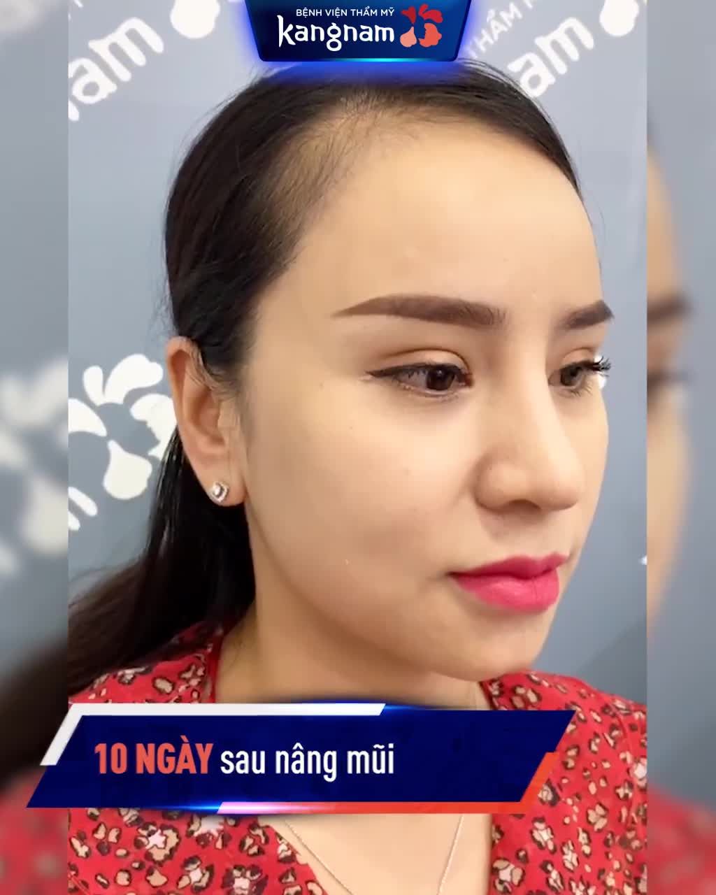 XAO XUYẾN với dáng MŨI NANOFORM sau 10 ngày