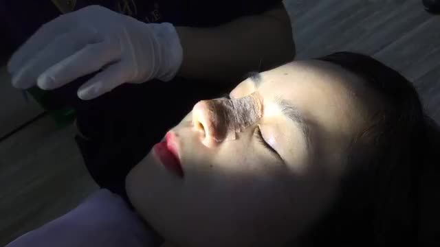 Khách hàng quay trở lại Dr.Hải Lê cắt chỉ sau khi nâng mũi Demi 5D - gương mặt của khách hàng thay đổi và trở nên xinh đẹp hơn.
