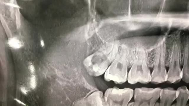Nhổ răng khôn lệch má, sâu sát tuỷ cho khách hàng tại Nha Khoa Thùy Anh.