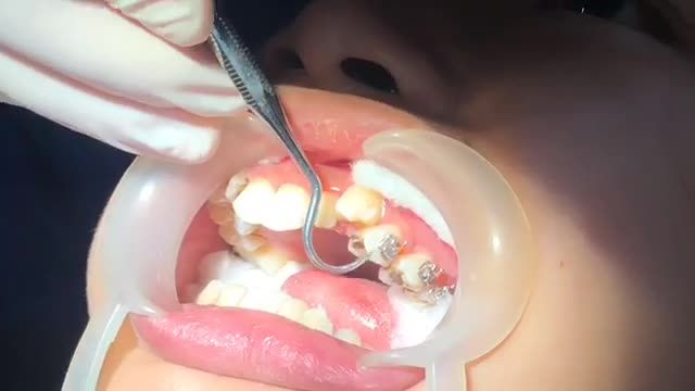 Gắn mắc cài cho khách hàng răng khấp khểnh - cắn sâu