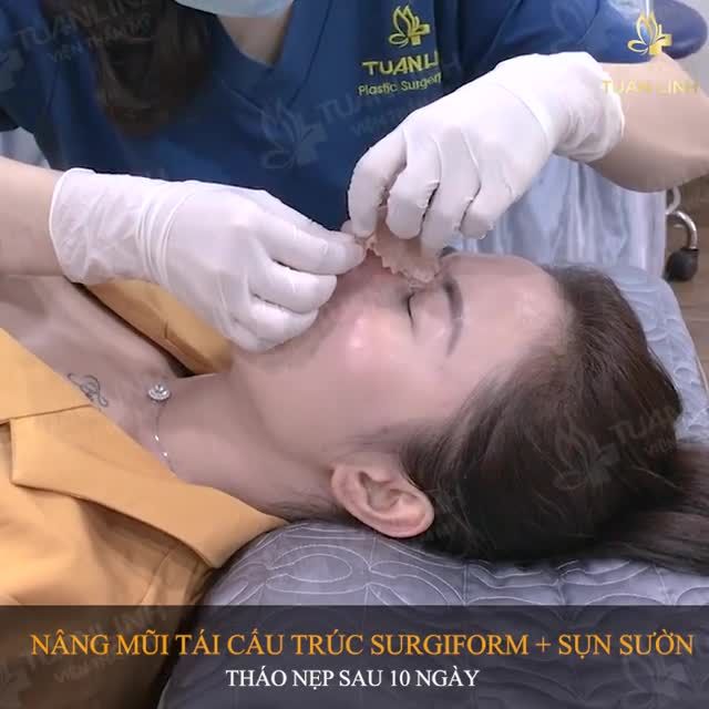Muốn nâng mũi đẹp click ngay vào clip dưới đây