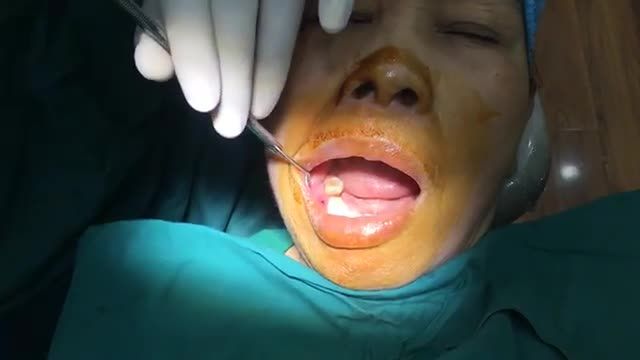 Quá trình cấy ghép implant cho cô Thuỷ , rắng số 46.