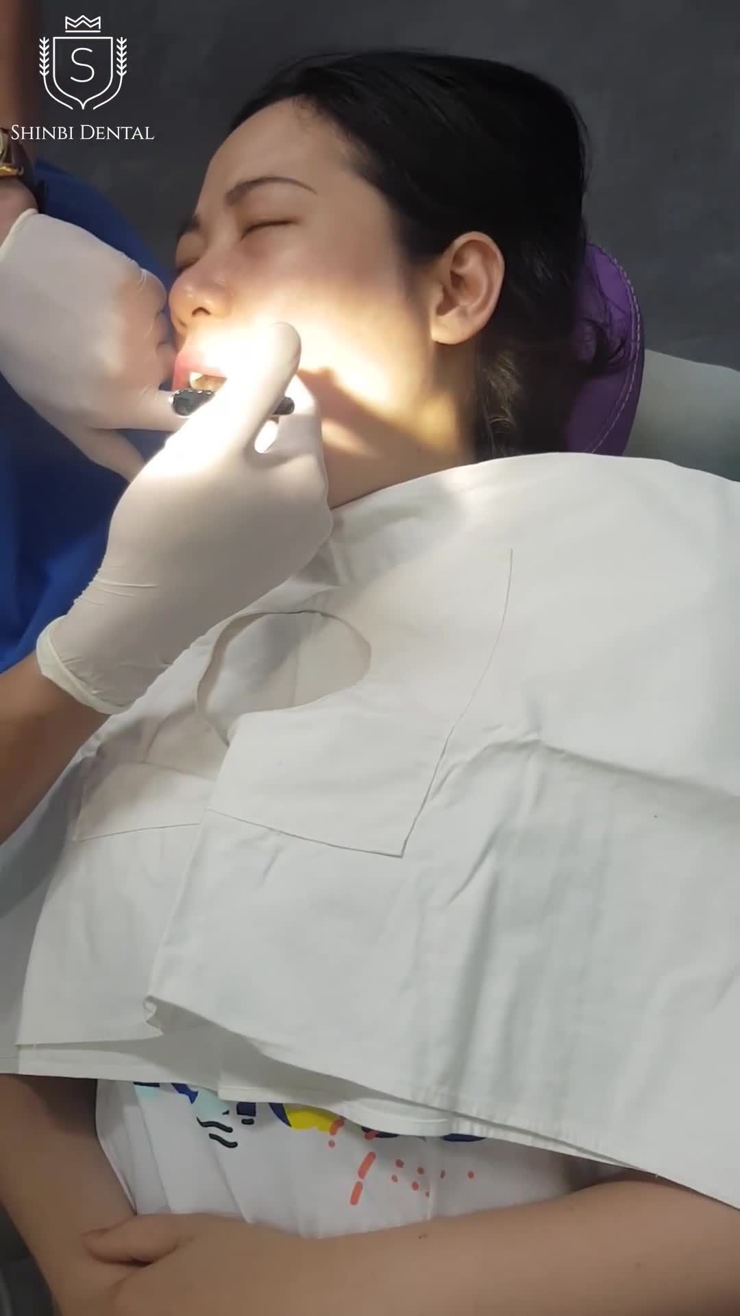 Toàn cảnh quá trình nhổ 2 răng "khôn" vô cùng nhẹ nhàng tại Shinbi