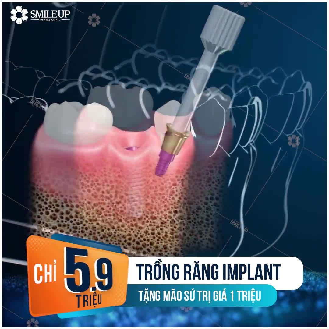 TRỒNG RĂNG 1 LẦN SỬ DỤNG TRỌN ĐỜI.