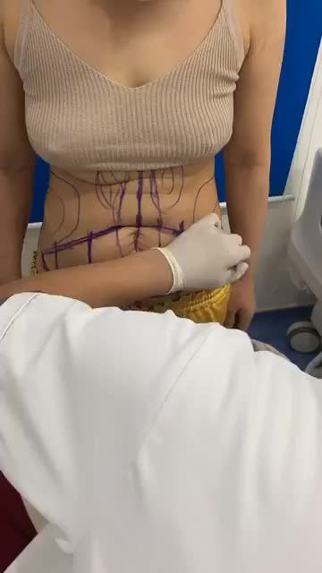 Bs Kangnam phân tích HÚT MỠ - TẠO HÌNH BỤNG Muốn làm đẹp an toàn hãy tới với kangnam
