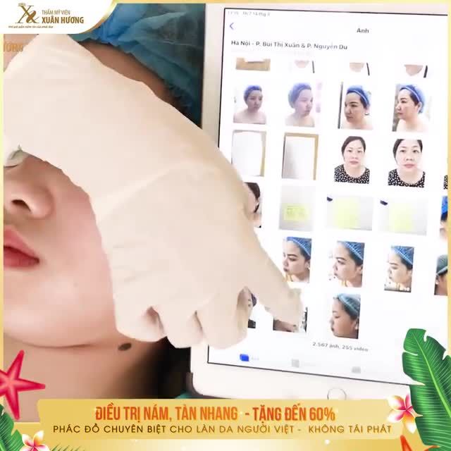 "BÓC MẼ" LÀN DA THẬT SAU LỚP KEM CHE KHUYẾT ĐIỂM LỘ RÕ TÀN NHANG KÍN MÁ, ĐEN ĐẬM NHIỀU KÍCH THƯỚC KHÁC NHAU