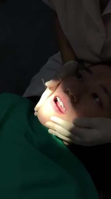 Gắn mắc cài tại nha khoa Shinbi