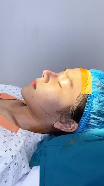 MŨI TIÊM FILLER NÂNG LẠI MŨI CẤU TRÚC