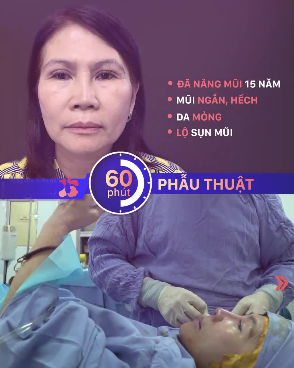 Quyết định TRAO CƠ HỘI THỨ 2 CHO MŨI sau 15 năm nâng mũi bằng công nghệ cũ, nữ KH lựa chọn Nâng mũi cấu trúc 4D Nanoform