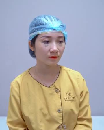 Cùng ngắm nhìn kết quả của vị khách hàng vừa thực hiện cắt mí dưới tại Dr.Hải Lê