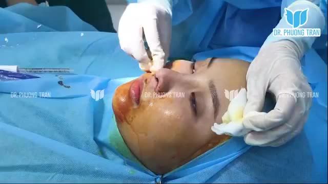 Bạn gái sống mũi cực thấp, ngắn bẩm sinh cuối cùng đã quyết định nâng mũi cấu trúc