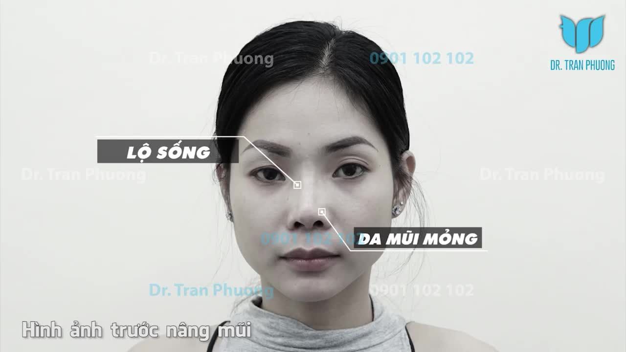 BẠN KHÁCH HÀNG NGƯỜI CAMPUCHIA TRẢI LÒNG SAU 14 NGÀY NÂNG MŨI CÙNG BÁC SĨ TRẦN PHƯƠNG