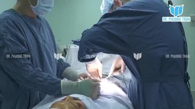 CA NÂNG MŨI SỤN SƯỜN KHẮC PHỤC TÌNH TRẠNG MŨI NGẮN, LỘ SỐNG, LUNG LAY