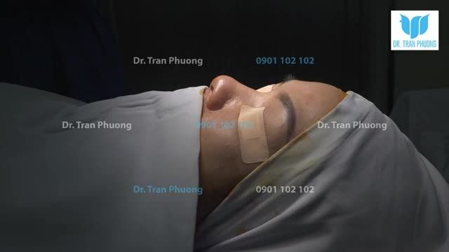 CA PHẪU THUẬT ĐẶC BIỆT: NÂNG MŨI SỤN SƯỜN TOÀN PHẦN