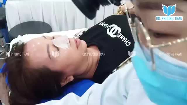 CẬN CẢNH HÌNH ẢNH KHÁCH HÀNG SAU NGÀY ĐẦU TIÊN NÂNG MŨI