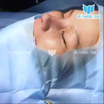 QUÁ TRÌNH KHÂU ĐÓNG VẾT THƯƠNG, HOÀN THIỆN CA NÂNG MŨI SỤN SƯỜN SURGIFORM KẾT HỢP PHỦ MERGADERM