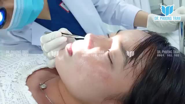 Hành trình 4 lần sửa mũi đầy gian nan
