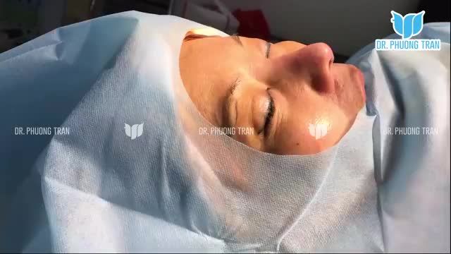 KẾT QUẢ NGAY SAU CA NÂNG MŨI SỤN SƯỜN TỰ THÂN TRÊN BỆNH NHÂN ĐÃ TỪNG ĐẶT SILICONE