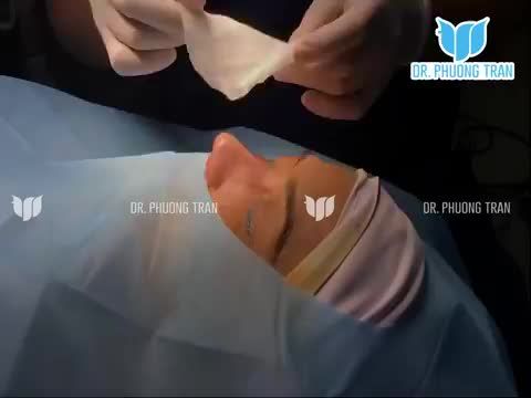 Kết quả ngoạn mục ở bệnh nhân từng sửa mũi 4 lần