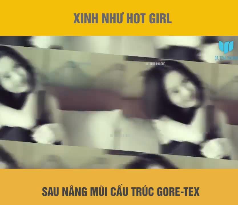 KHÁCH HÀNG CHIA SẺ CẢM NHẬN SAU 2 TUẦN NÂNG MŨI VÀ ĐỘN CẰM