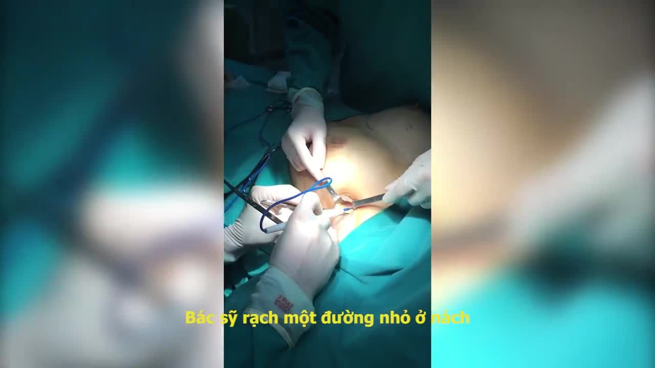 Kỹ thuật nâng ngực cực ít chảy máu