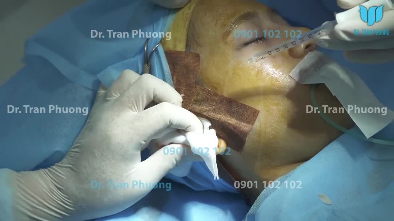 LẤY SỤN TAI CÓ LÂU KHÔNG? BẠN NÀO TÒ MÒ ĐỪNG BỎ QUA VIDEO NÀY!