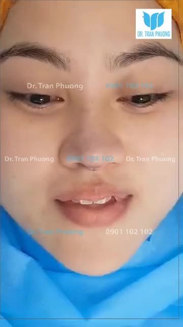 NÂNG MŨI HOÀN TOÀN KHÔNG ĐAU BẠN KHÔNG TIN? KIỂM CHỨNG NGAY