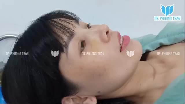Nếu có điểm 10, cho bác sĩ luôn 10 điểm - khách hàng nói sau 14 ngày nâng mũi cấu trúc Surgiform