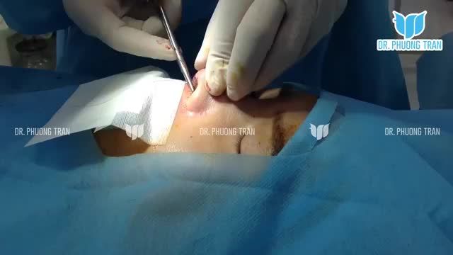 QUÁ TRÌNH KHÂU ĐÓNG VẾT THƯƠNG, HOÀN THÀNH CA MŨI CẤU TRÚC KHẮC PHỤC MŨI NGẮN