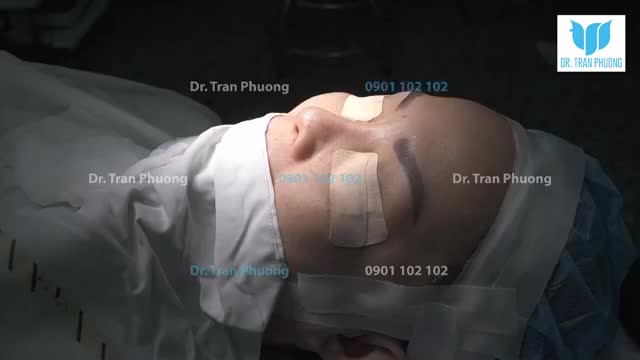 SỬA LẠI DÁNG MŨI CHO CHỊ VIỆT KIỀU CANADA ĐÃ TỪNG NÂNG MŨI BẰNG KỸ THUẬT CŨ NHIỀU NĂM TRƯỚC ĐÂY