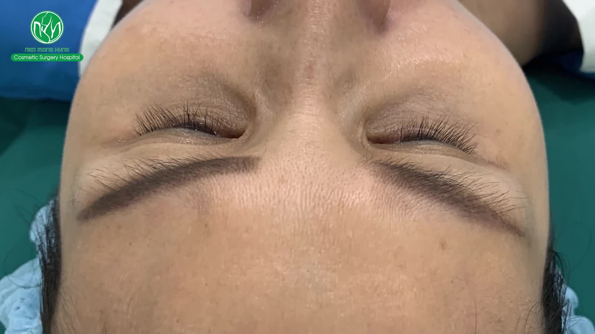 Ca tiêm mỡ tự thân được thực hiện tại Bệnh viện Thẩm mỹ Ngô Mộng Hùng