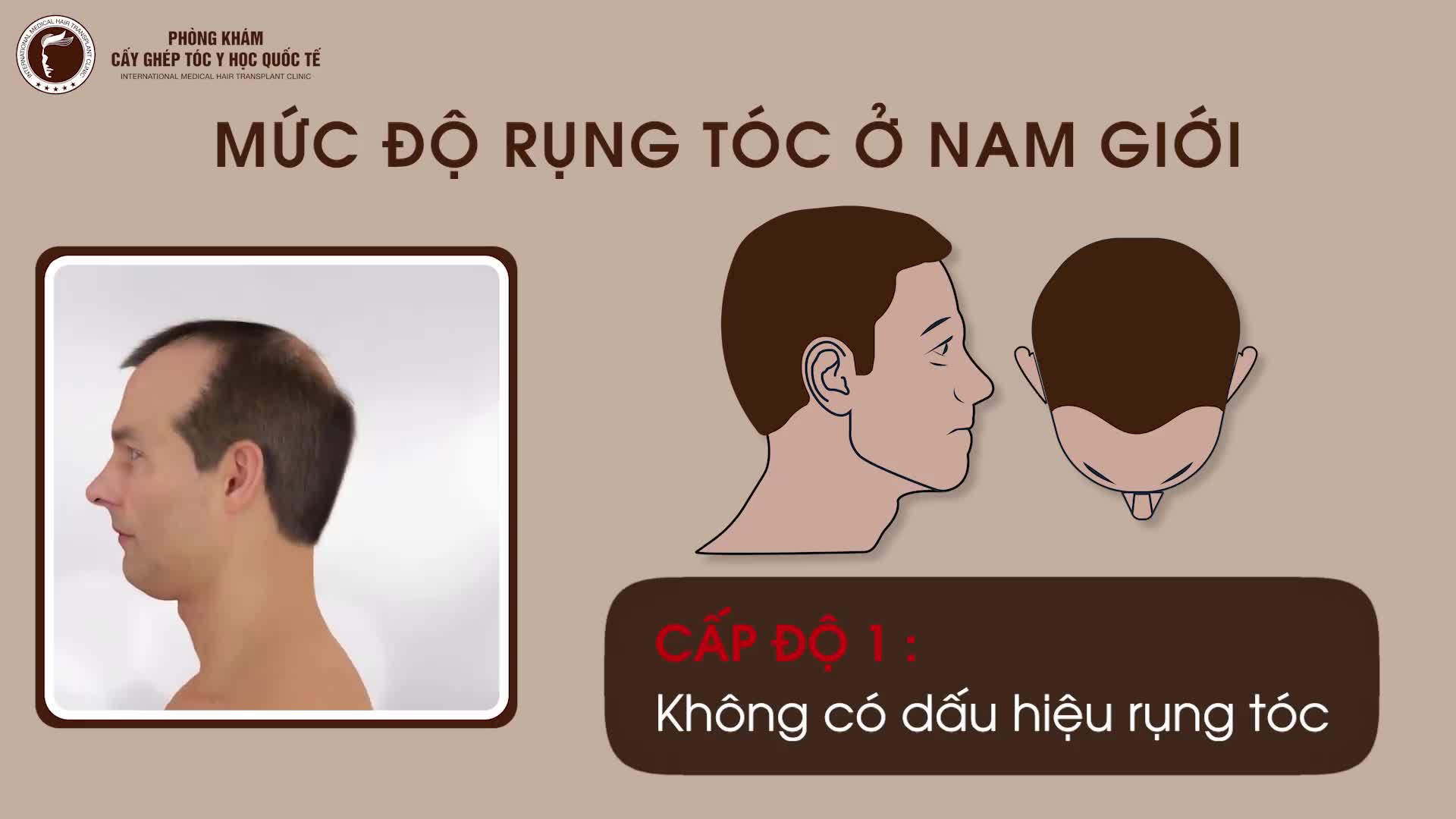 Các cấp độ rụng tóc nam giới