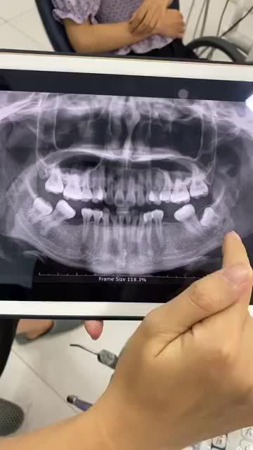 RĂNG 8 ĐỔ SANG RĂNG SỐ 7 GÂY KHÓ CHỊU, XÔ LỆCH CẢ HÀM - PHẢI LÀM SAO?