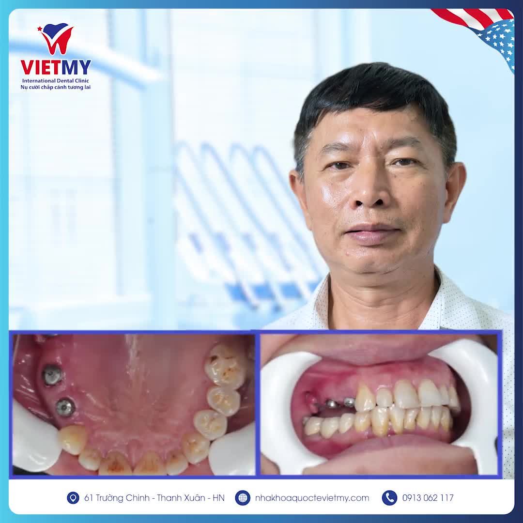 VƯỢT ĐƯỜNG XA XÔI TỪ HÀ TĨNH ĐẾN HÀ NỘI TRỒNG RĂNG IMPLANT- TẠI SAO KHÔNG?