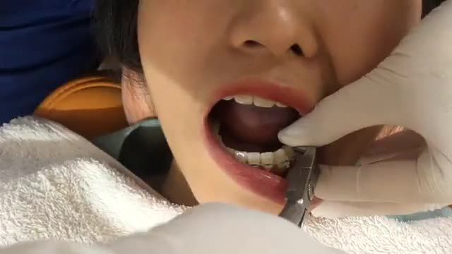 BUNG LỤA CHO KHÁCH HÀNG RĂNG KHẤP KHỂNH, CẮN CHÉO RĂNG CỬA