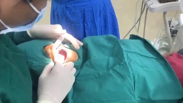 Cấy 2 chân răng nhân tạo R11 và R22