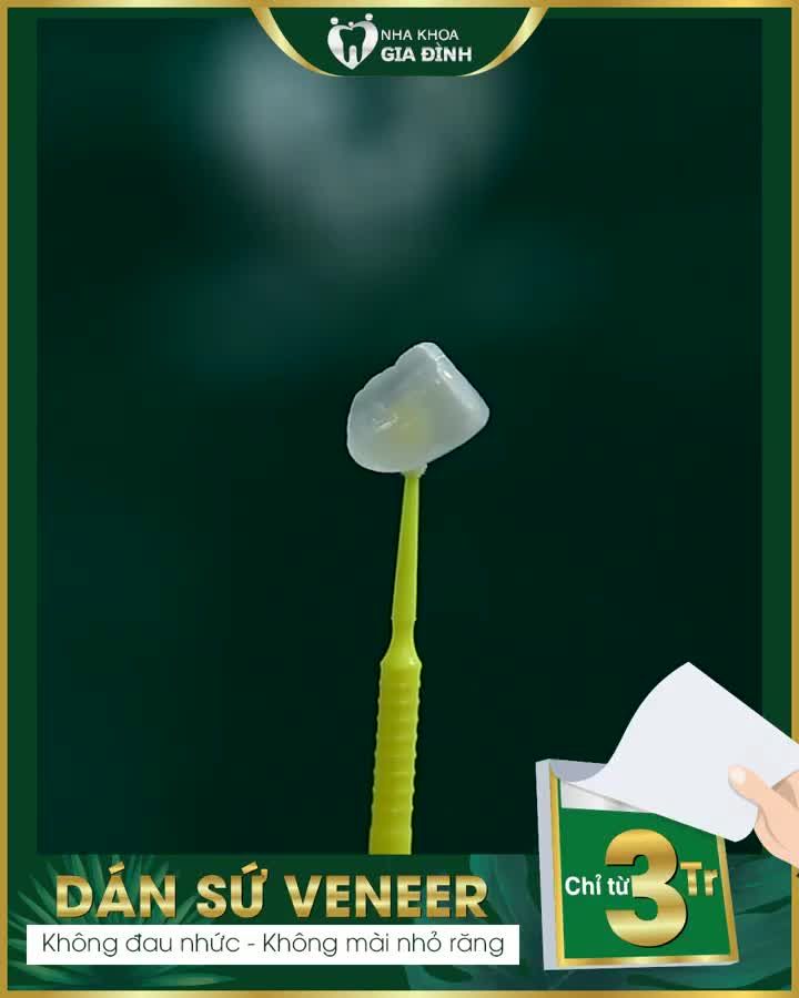 DÁN SỨ VENEER: TÂN TRANG NỤ CƯỜI RẠNG NGỜI NHƯ DÀN SAO VIỆT