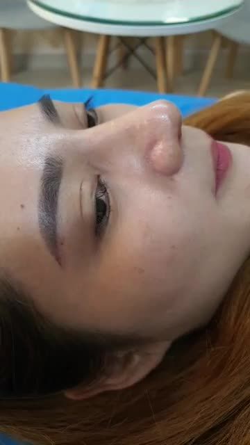 Nâng mũi cấu trúc đa lớp Dáng Sline kết hợp Lline Sau 10 ngày