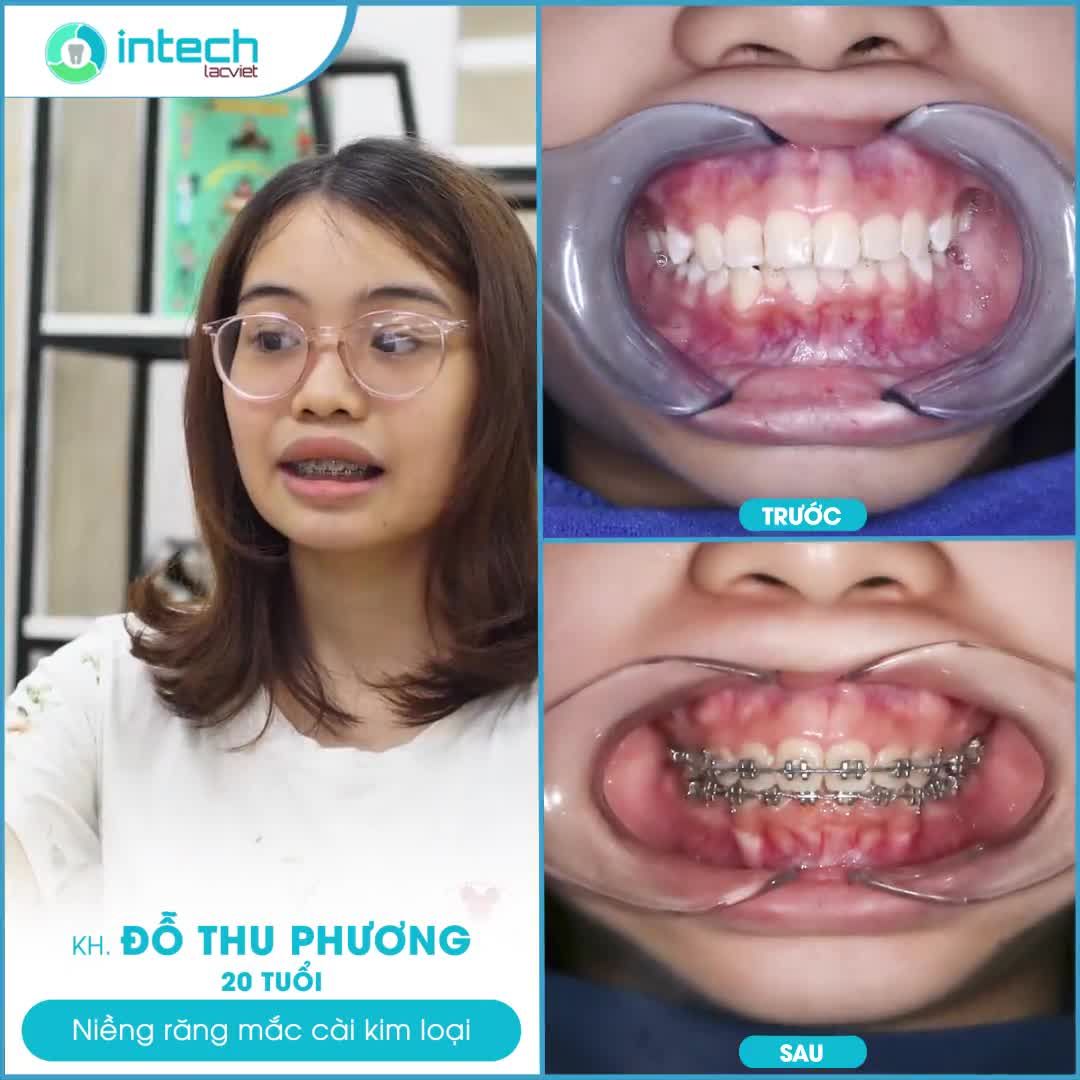 NỤ CƯỜI TƯƠI TẮN NHỜ NIỀNG RĂNG TẠI NHA KHOA LẠC VIỆT INTECH