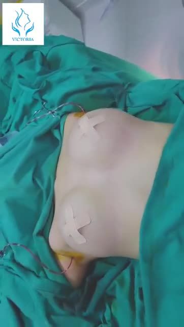 VỪA THỰC HIỆN XONG CA NÂNG NGỰC NỘI SOI TẠI BV