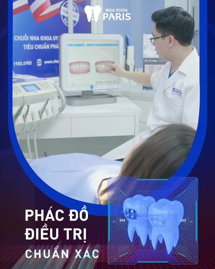 NIỀNG RĂNG 3D SPEED GIÁ TỐT NHẤT HÀ NỘI CHỈ TỪ 24TR