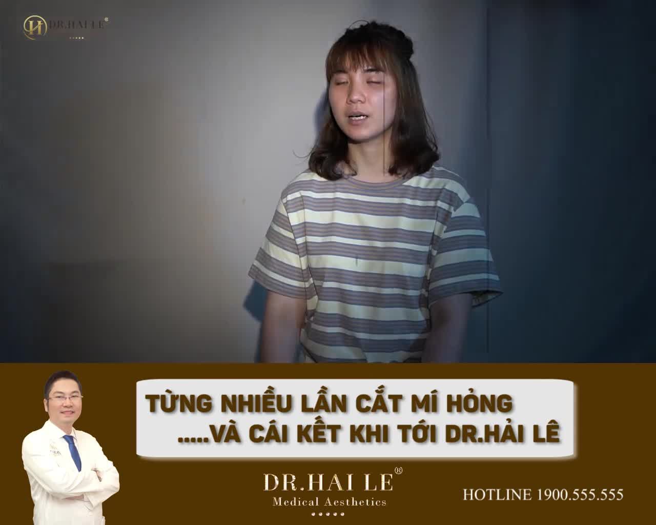 Sửa mí Deep Tech20 tại VTM Dr.Hải Lê đã được thực hiện thành công +1000 khách hàng.