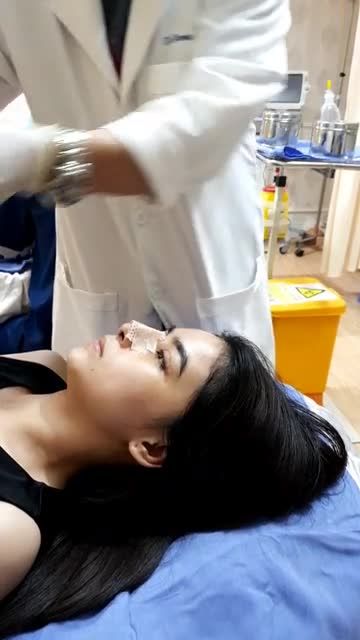 Quy trình thay nẹp mũi sau nâng 5 ngày tại Kanngam