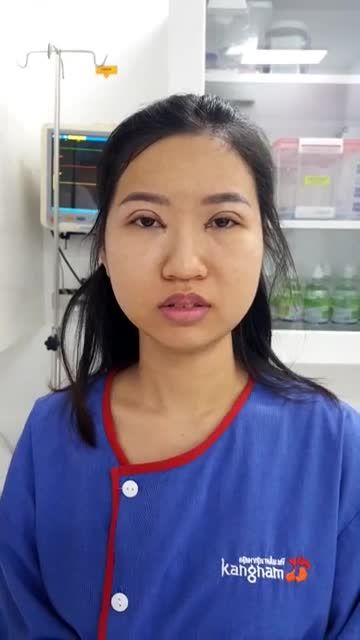 Kết quả Cắt mí trên Plasma và tạo khoé mắt