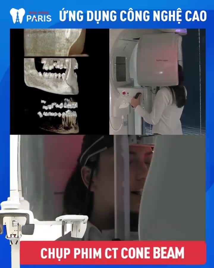 Mất răng toàn hàm - Ăn nhai kém - Khuôn hàm móm mém